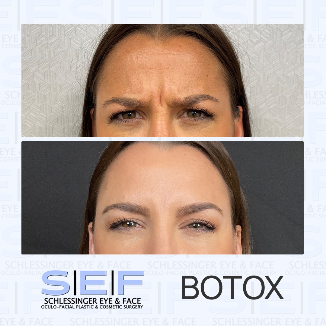 Myths About Botox Debunked Schlessinger Eye And Face