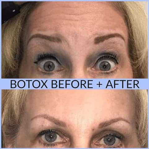 Could use of a medical tens unit forehead device migrate Botox or break  down Juvederm in the frown lines or forehead? (Photo)