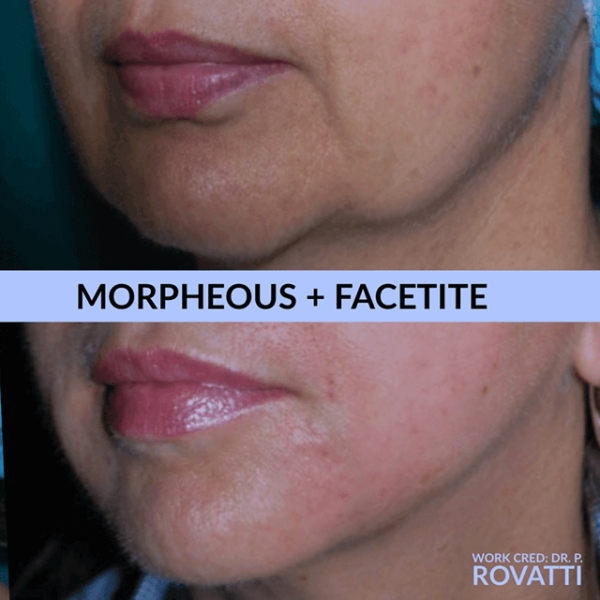 How Morpheus and Facetite Can Rejuvenate Your Neck and Face ...