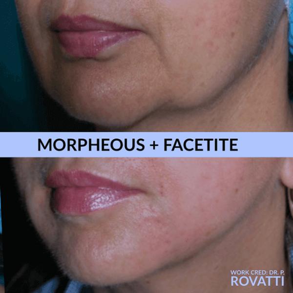 Facetite Before & After Gallery 