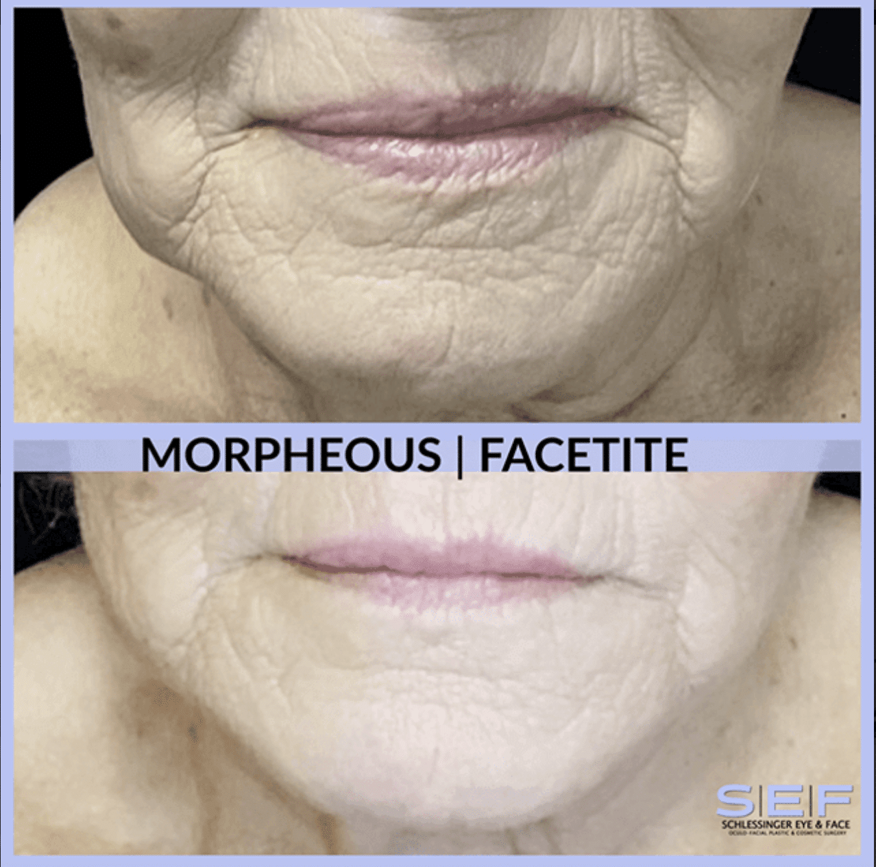 Who Is a Good Candidate for Facetite? : Schlessinger Eye and Face