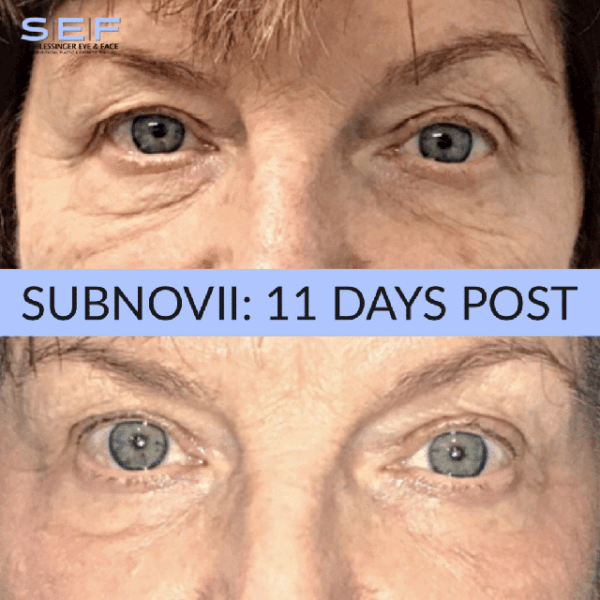 Subnovii Before And After Gallery Schlessinger Eye And Face Woodbury Ny 